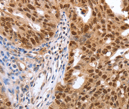 Immunohistochemistry of paraffin-embedded Human ovarian cancer using PARP1 Polyclonal Antibody at dilution of 1:40