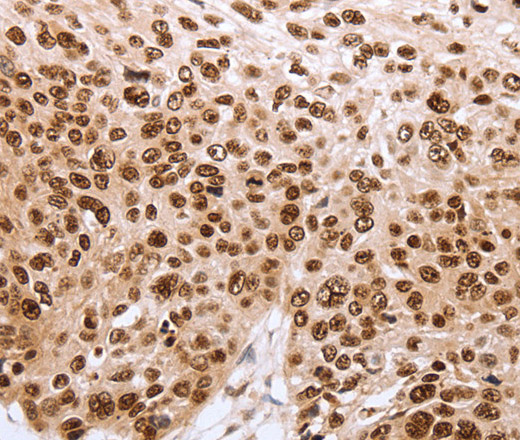 Immunohistochemistry of paraffin-embedded Human esophagus cancer using PARP1 Polyclonal Antibody at dilution of 1:40