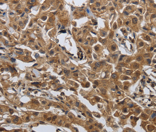 Immunohistochemistry of paraffin-embedded Human lung cancer tissue using PDCD7 Polyclonal Antibody at dilution 1:60