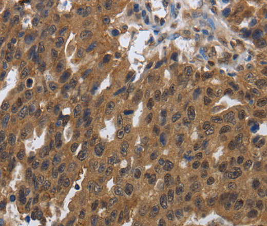 Immunohistochemistry of paraffin-embedded Human ovarian cancer tissue using PDCD7 Polyclonal Antibody at dilution 1:60