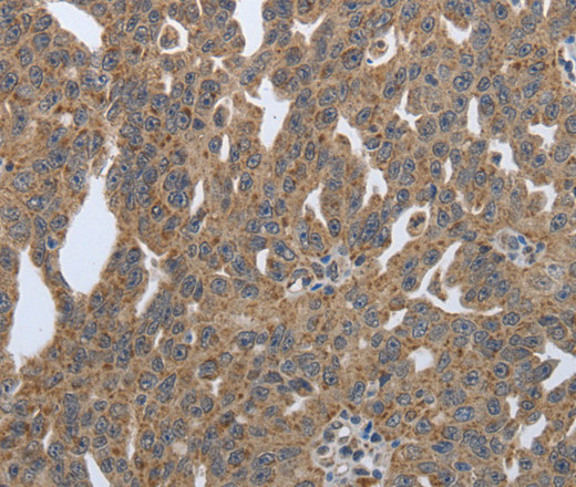 Immunohistochemistry of paraffin-embedded Human ovarian cancer tissue using PDIA2 Polyclonal Antibody at dilution 1:50