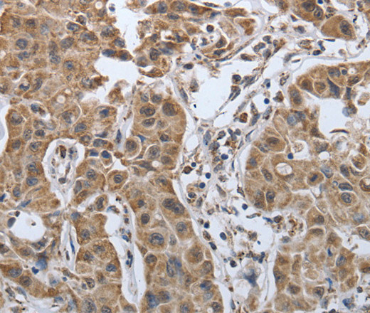 Immunohistochemistry of paraffin-embedded Human lung cancer tissue using PDIA2 Polyclonal Antibody at dilution 1:50