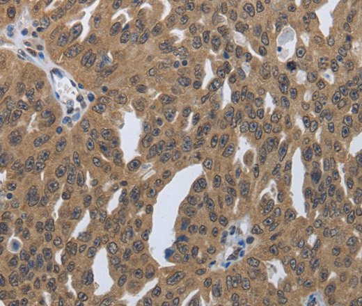 Immunohistochemistry of paraffin-embedded Human ovarian cancer tissue using PRKAR1B Polyclonal Antibody at dilution 1:60