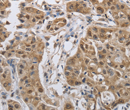 Immunohistochemistry of paraffin-embedded Human lung cancer tissue using PRKAR1B Polyclonal Antibody at dilution 1:60