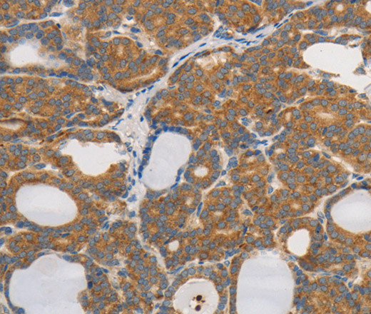 Immunohistochemistry of paraffin-embedded Human thyroid cancer tissue using PPP2CB Polyclonal Antibody at dilution 1:80