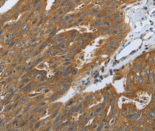 Immunohistochemistry of paraffin-embedded Human ovarian cancer tissue using DLG4 Polyclonal Antibody at dilution 1:40