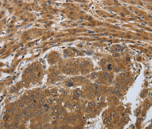 Immunohistochemistry of paraffin-embedded Human liver cancer using PSMD6 Polyclonal Antibody at dilution of 1:50