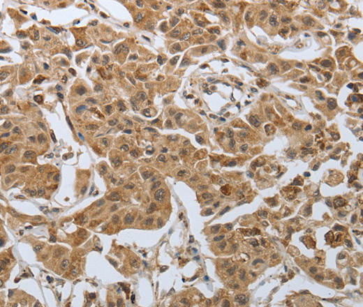 Immunohistochemistry of paraffin-embedded Human lung cancer using PSMD6 Polyclonal Antibody at dilution of 1:50