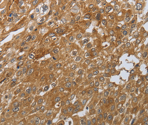 Immunohistochemistry of paraffin-embedded Human esophagus cancer tissue using PTPRM Polyclonal Antibody at dilution 1:80