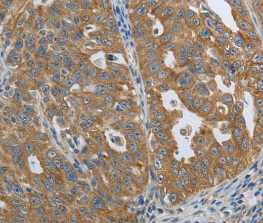 Immunohistochemistry of paraffin-embedded Human ovarian cancer tissue using PTPRM Polyclonal Antibody at dilution 1:80