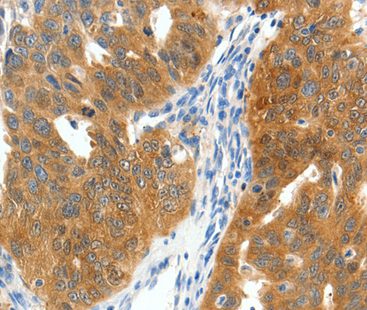 Immunohistochemistry of paraffin-embedded Human ovarian cancer tissue using SCN9A Polyclonal Antibody at dilution 1:40