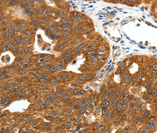 Immunohistochemistry of paraffin-embedded Human ovarian cancer tissue using SCN11A Polyclonal Antibody at dilution 1:50