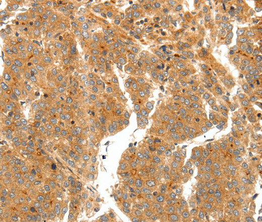 Immunohistochemistry of paraffin-embedded Human liver cancer tissue using SCT Polyclonal Antibody at dilution 1:60