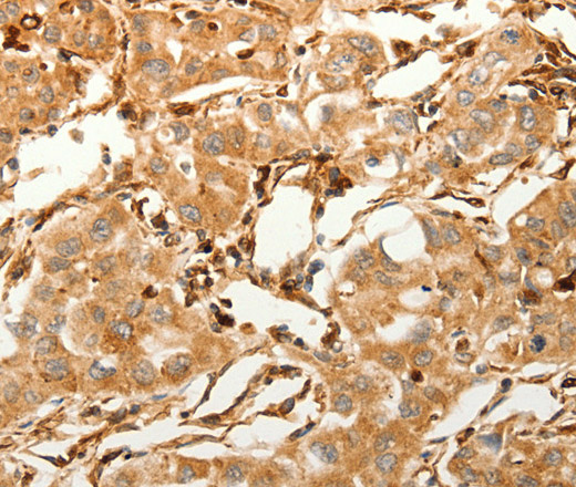 Immunohistochemistry of paraffin-embedded Human lung cancer tissue using SFRP1 Polyclonal Antibody at dilution 1:80