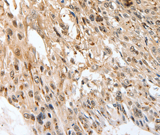 Immunohistochemistry of paraffin-embedded Human esophagus cancer tissue using SLC1A7 Polyclonal Antibody at dilution 1:60