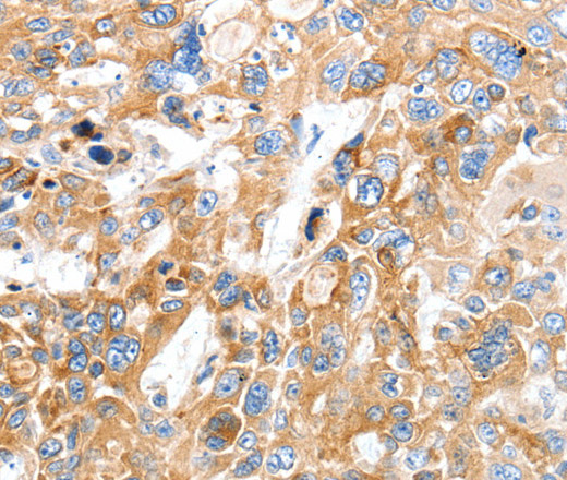 Immunohistochemistry of paraffin-embedded Human esophagus cancer using SLC22A17 Polyclonal Antibody at dilution of 1:30