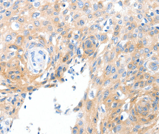 Immunohistochemistry of paraffin-embedded Human cervical cancer using SLC22A17 Polyclonal Antibody at dilution of 1:30