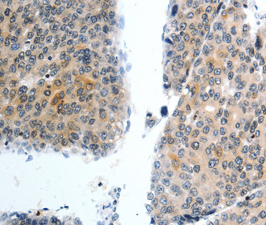 Immunohistochemistry of paraffin-embedded Human liver cancer using Oct-3 Polyclonal Antibody at dilution of 1:40