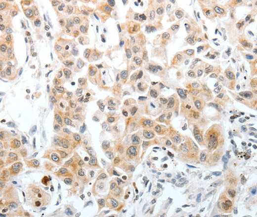 Immunohistochemistry of paraffin-embedded Human lung cancer using Oct-3 Polyclonal Antibody at dilution of 1:40