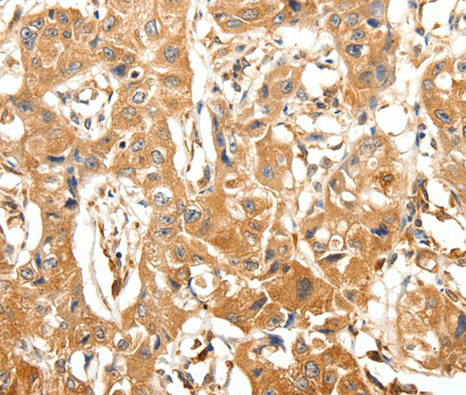 Immunohistochemistry of paraffin-embedded Human lung cancer tissue using SLC27A1 Polyclonal Antibody at dilution 1:40