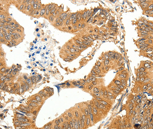 Immunohistochemistry of paraffin-embedded Human colon cancer using SLC32A1 Polyclonal Antibody at dilution of 1:35