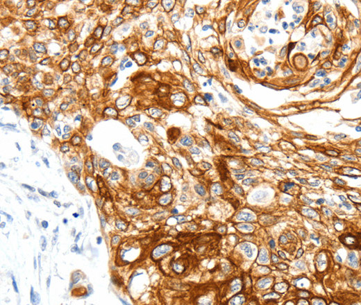 Immunohistochemistry of paraffin-embedded Human cervical cancer tissue using SIPA1 Polyclonal Antibody at dilution 1:40