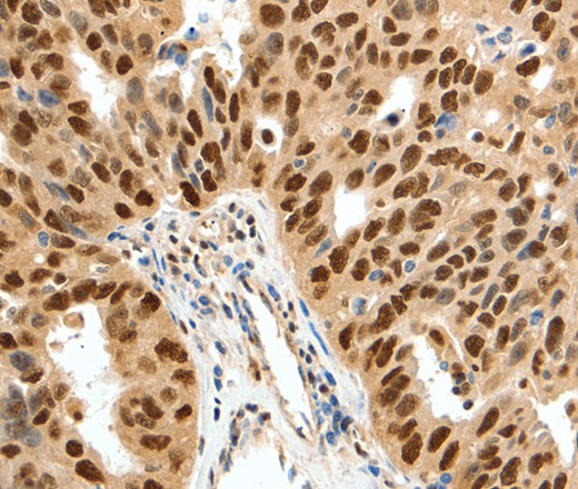 Immunohistochemistry of paraffin-embedded Human ovarian cancer tissue using SSB Polyclonal Antibody at dilution 1:50