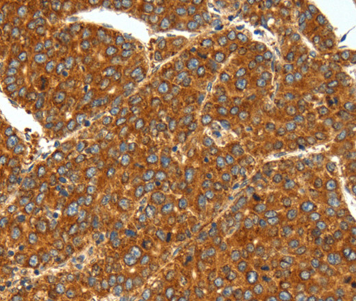 Immunohistochemistry of paraffin-embedded Human liver cancer using SSTR1 Polyclonal Antibody at dilution of 1:40