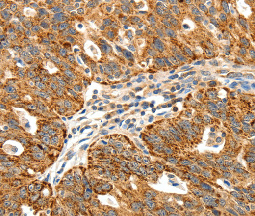 Immunohistochemistry of paraffin-embedded Human ovarian cancer using SSTR1 Polyclonal Antibody at dilution of 1:40