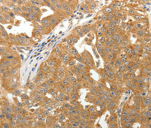 Immunohistochemistry of paraffin-embedded Human ovarian cancer tissue using MAP1B  Polyclonal Antibody at dilution 1:40
