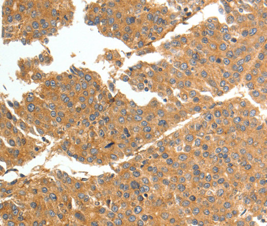 Immunohistochemistry of paraffin-embedded Human liver cancer tissue using TNN Polyclonal Antibody at dilution 1:50