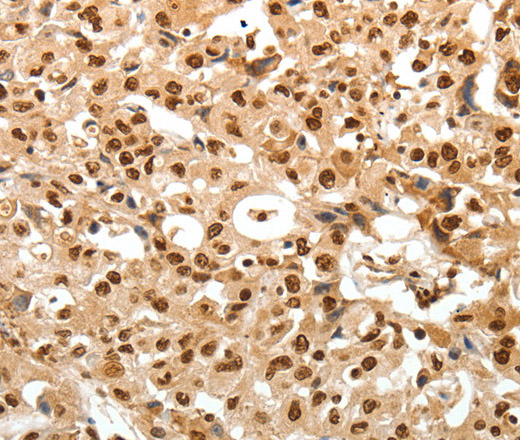 Immunohistochemistry of paraffin-embedded Human ovarian cancer tissue using TNXB Polyclonal Antibody at dilution 1:30