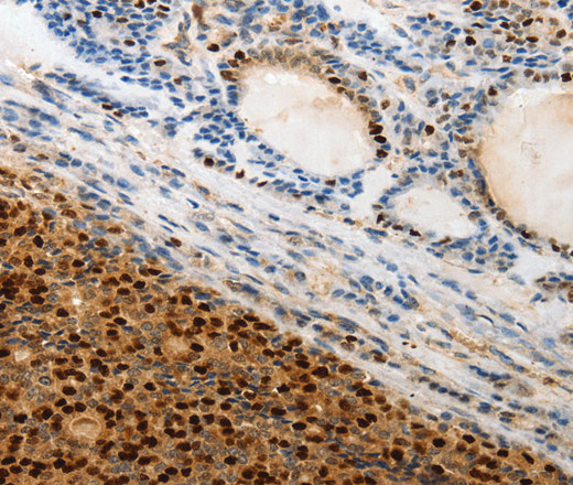 Immunohistochemistry of paraffin-embedded Human thyroid cancer tissue using TERT Polyclonal Antibody at dilution 1:50