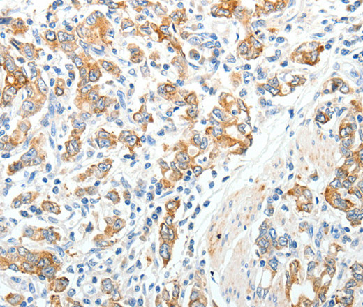 Immunohistochemistry of paraffin-embedded Human gastric cancer tissue using TEP1 Polyclonal Antibody at dilution 1:40