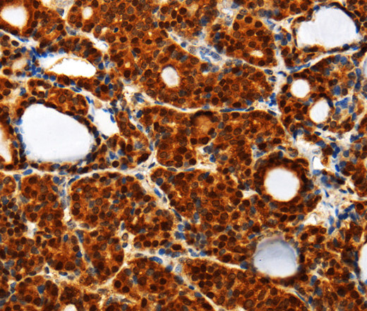 Immunohistochemistry of paraffin-embedded Human thyroid cancer using TXN Polyclonal Antibody at dilution of 1:40