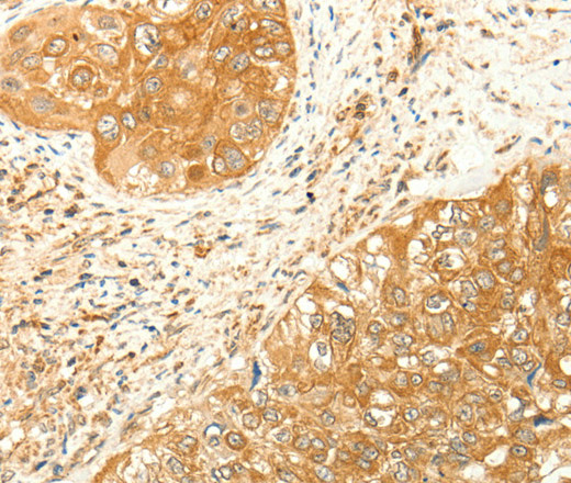 Immunohistochemistry of paraffin-embedded Human cervical cancer tissue using RARRES1 Polyclonal Antibody at dilution 1:60