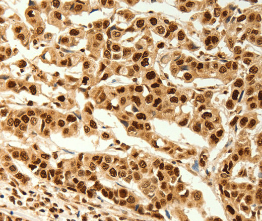 Immunohistochemistry of paraffin-embedded Human cervical cancer  tissue using C12orf5 Polyclonal Antibody at dilution 1:80