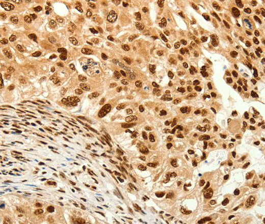 Immunohistochemistry of paraffin-embedded Human breast cancer  tissue using C12orf5 Polyclonal Antibody at dilution 1:80