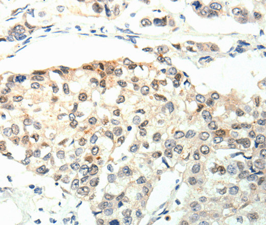 Immunohistochemistry of paraffin-embedded Human breast cancer using TPM2 Polyclonal Antibody at dilution of 1:60