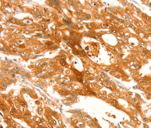 Immunohistochemistry of paraffin-embedded Human gasrtic cancer tissue using TRPM7 Polyclonal Antibody at dilution 1:30