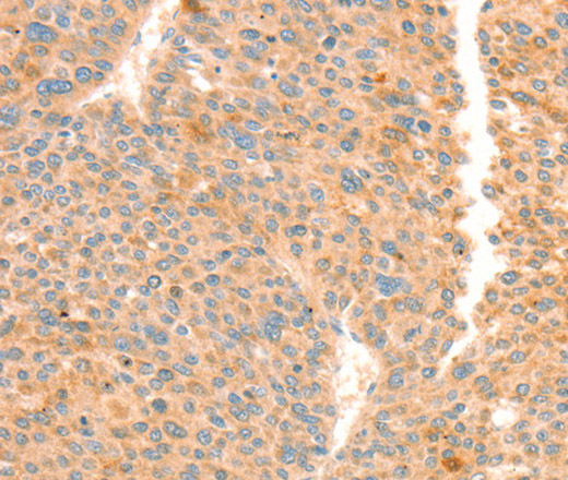 Immunohistochemistry of paraffin-embedded Human liver cancer tissue using TRPM7 Polyclonal Antibody at dilution 1:30