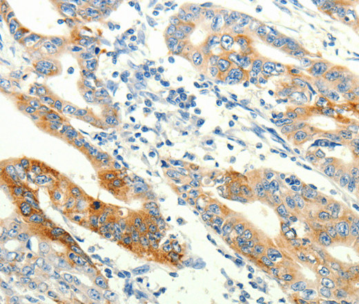 Immunohistochemistry of paraffin-embedded Human gasrtic cancer tissue using TRPA1 Polyclonal Antibody at dilution 1:60