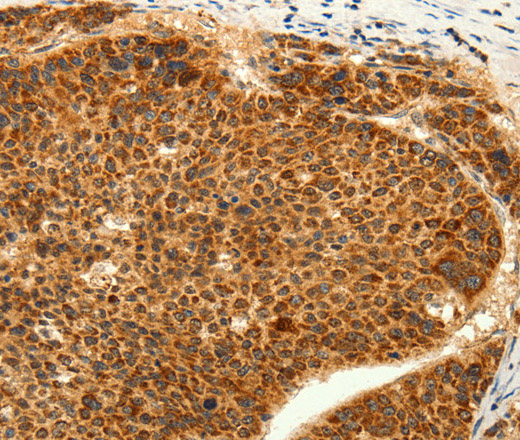 Immunohistochemistry of paraffin-embedded Human liver cancer tissue using TRPC6 Polyclonal Antibody at dilution 1:50