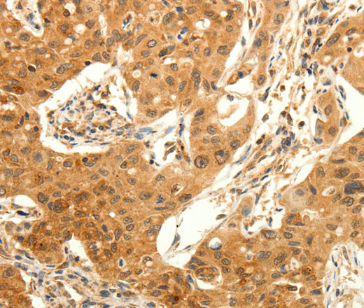 Immunohistochemistry of paraffin-embedded Human lung cancer tissue using TRPC6 Polyclonal Antibody at dilution 1:50