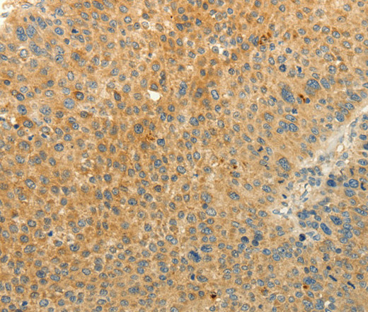 Immunohistochemistry of paraffin-embedded Human liver cancer tissue using EDG7 Polyclonal Antibody at dilution 1:40