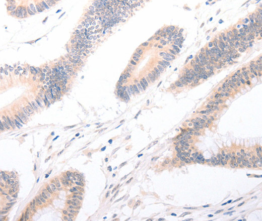 Immunohistochemistry of paraffin-embedded Human colon cancer tissue using CELSR2 Polyclonal Antibody at dilution 1:50