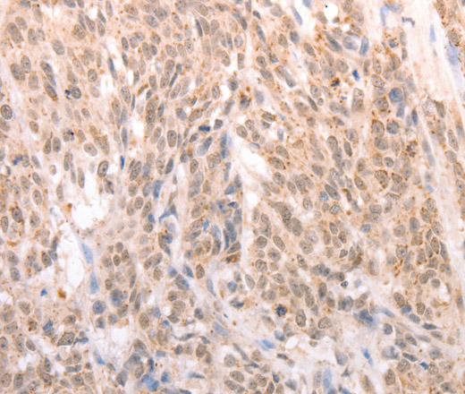 Immunohistochemistry of paraffin-embedded Human liver cancer tissue using ACIN1 Polyclonal Antibody at dilution 1:80