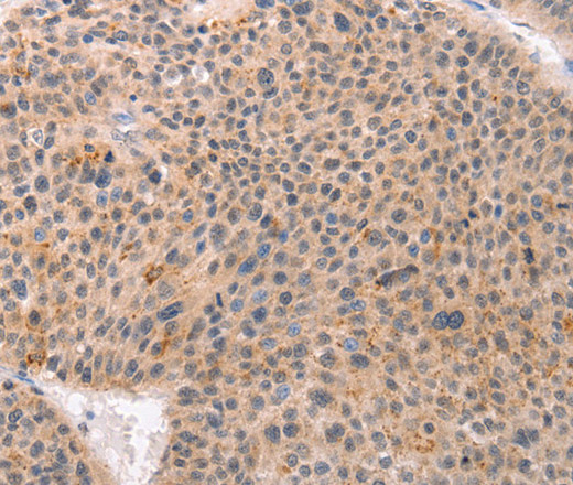 Immunohistochemistry of paraffin-embedded Human esophagus cancer tissue using ACIN1 Polyclonal Antibody at dilution 1:80