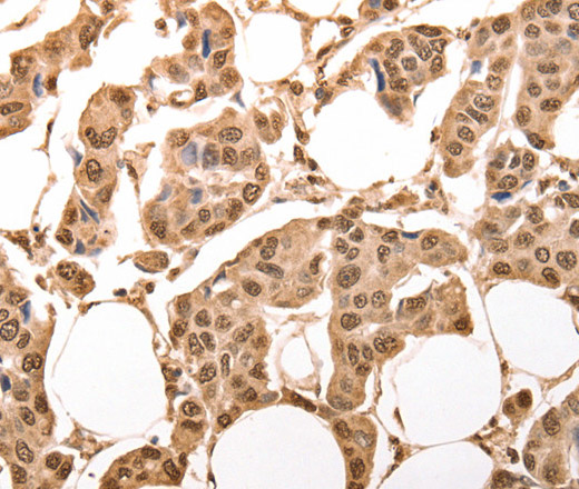 Immunohistochemistry of paraffin-embedded Human breast cancer using ACO2 Polyclonal Antibody at dilution of 1:30