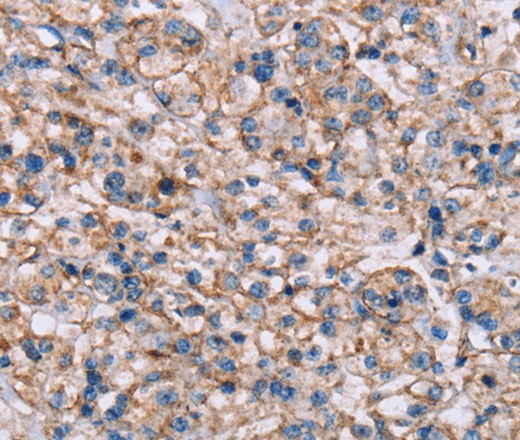 Immunohistochemistry of paraffin-embedded Human prostate cancer tissue using ADAM12 Polyclonal Antibody at dilution 1:40